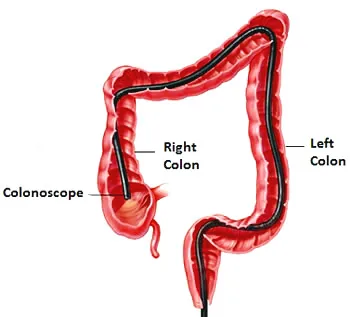 Colonoscopy diagram