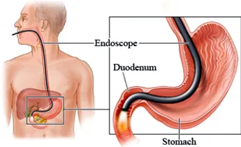 Endoscopy illustration