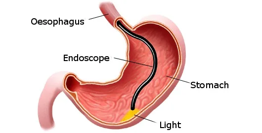 Gastroscopy diagram