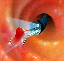 Polyp removal illustration